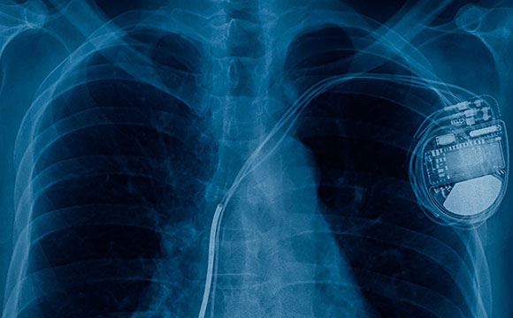 X Ray showing pacemaker