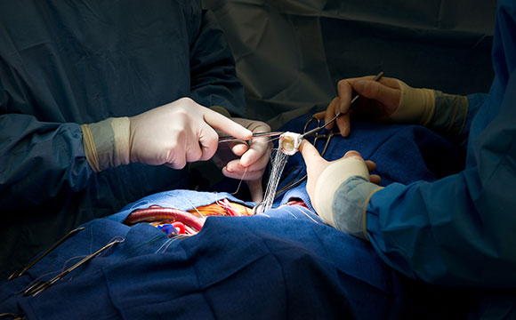 Open heart surgery